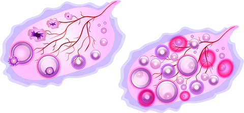 Comprendre le syndrome des ovaires polykystiques et son impact sur les règles